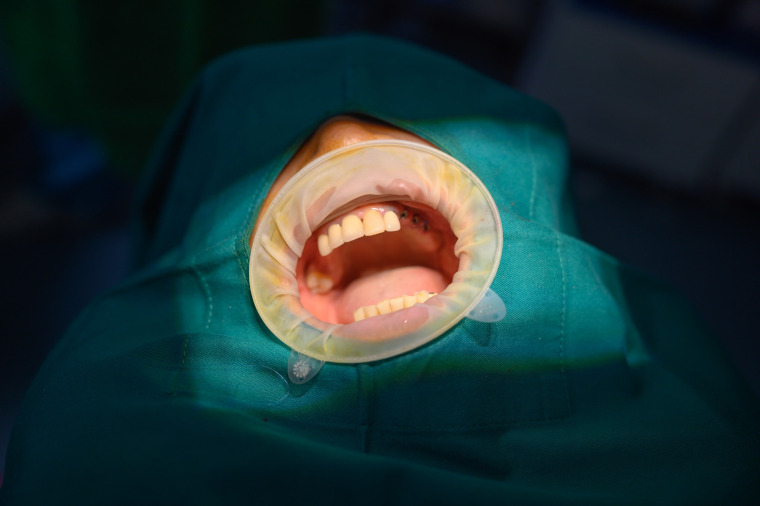 Congratulations to D-Care Dental Clinic on a successful multi-tooth dental implant surgery
